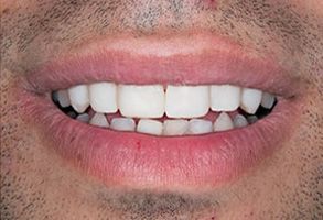 Syosset Family Dentist | Dental Bridges, Implant Dentistry and Teeth Whitening